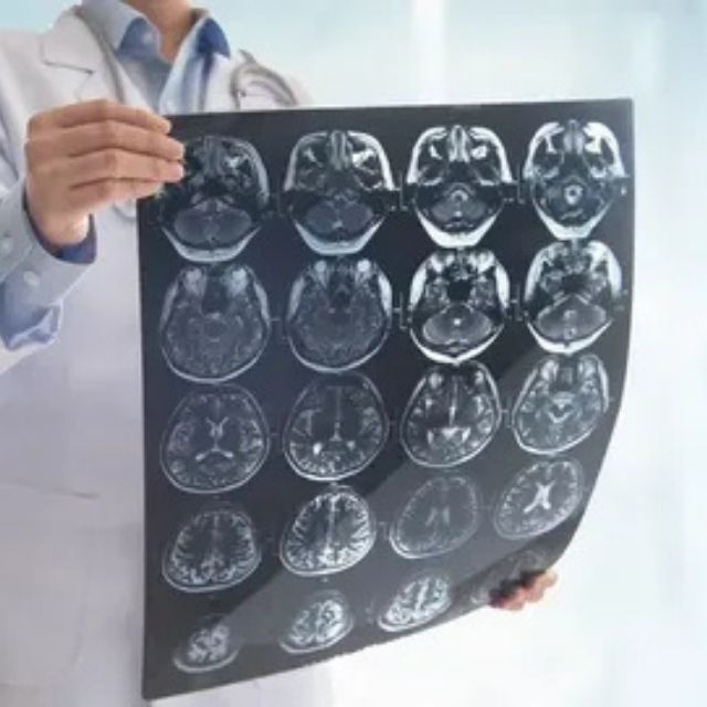 Ischemic Stroke Management in Mumbai